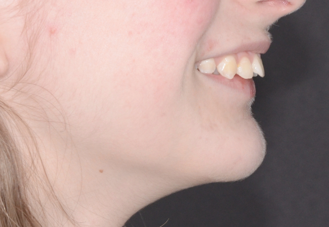 Antes